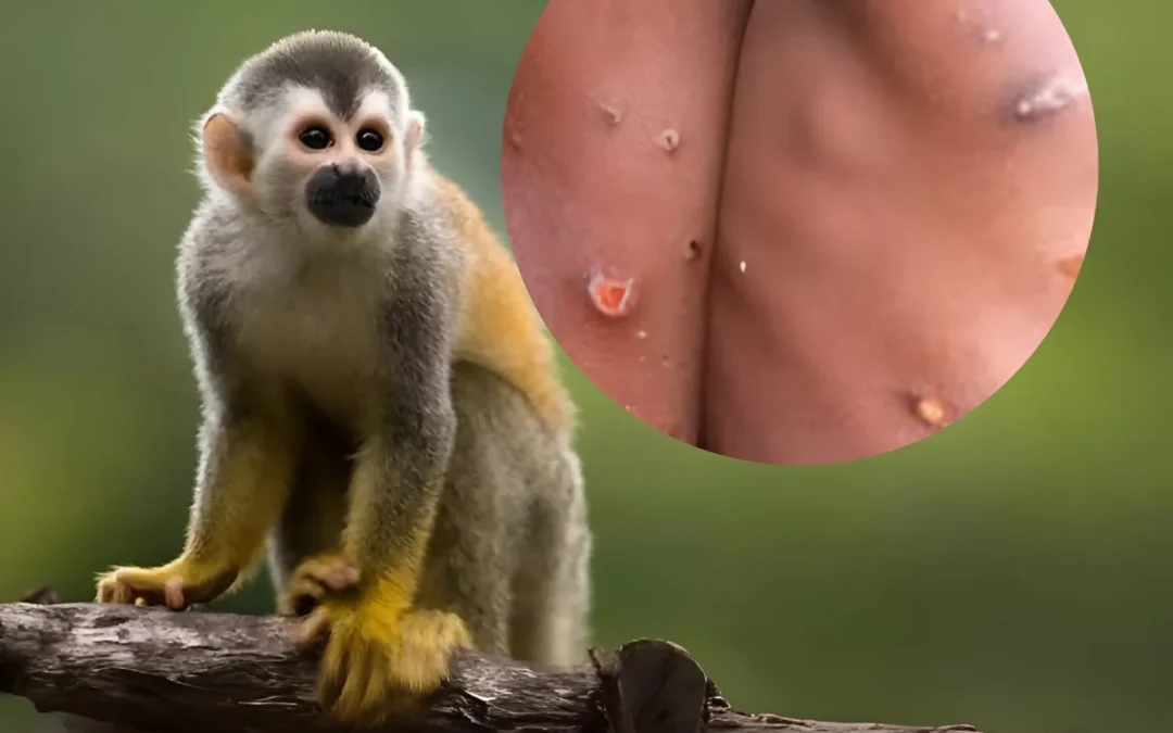 Se duplicaron los casos de viruela del mono en Argentina: ya hay 22 contagios