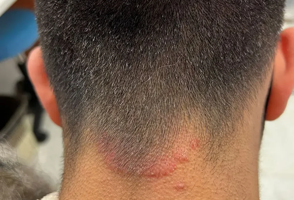 Alerta en barberías: advierten sobre contagio de un hongo que produce una infección en el cuero cabelludo