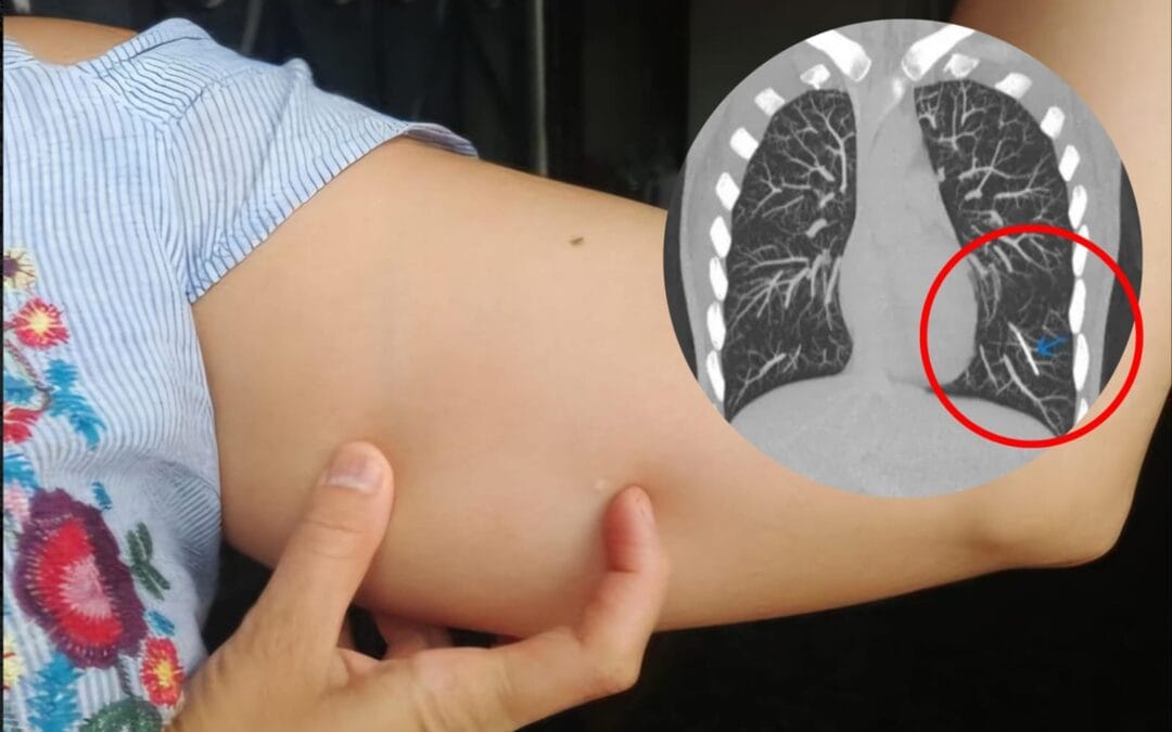 No sentía el implante anticonceptivo en su brazo: Lo tenía en el pulmón