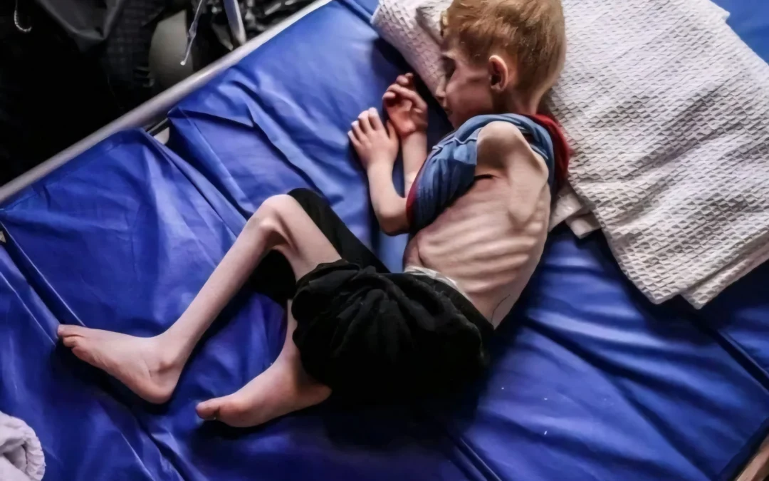 Murió otro nene por desnutrición en Gaza: Ya son 82 los menores que fallecieron por hambre