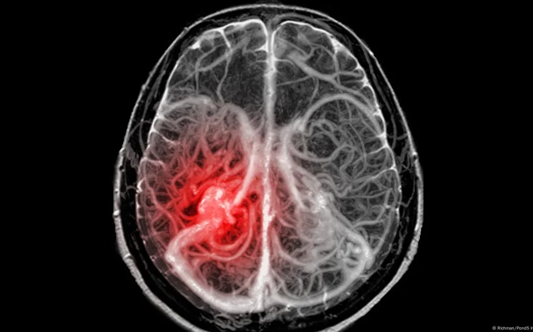 Científicos del CONICET lograron frenar el crecimiento de un cáncer cerebral letal