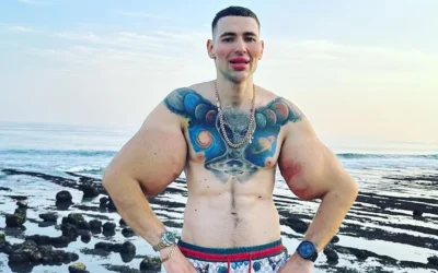 Se inyectó vaselina en los bíceps para hacerlos más grandes y ahora podría perder ambos brazos por una infección