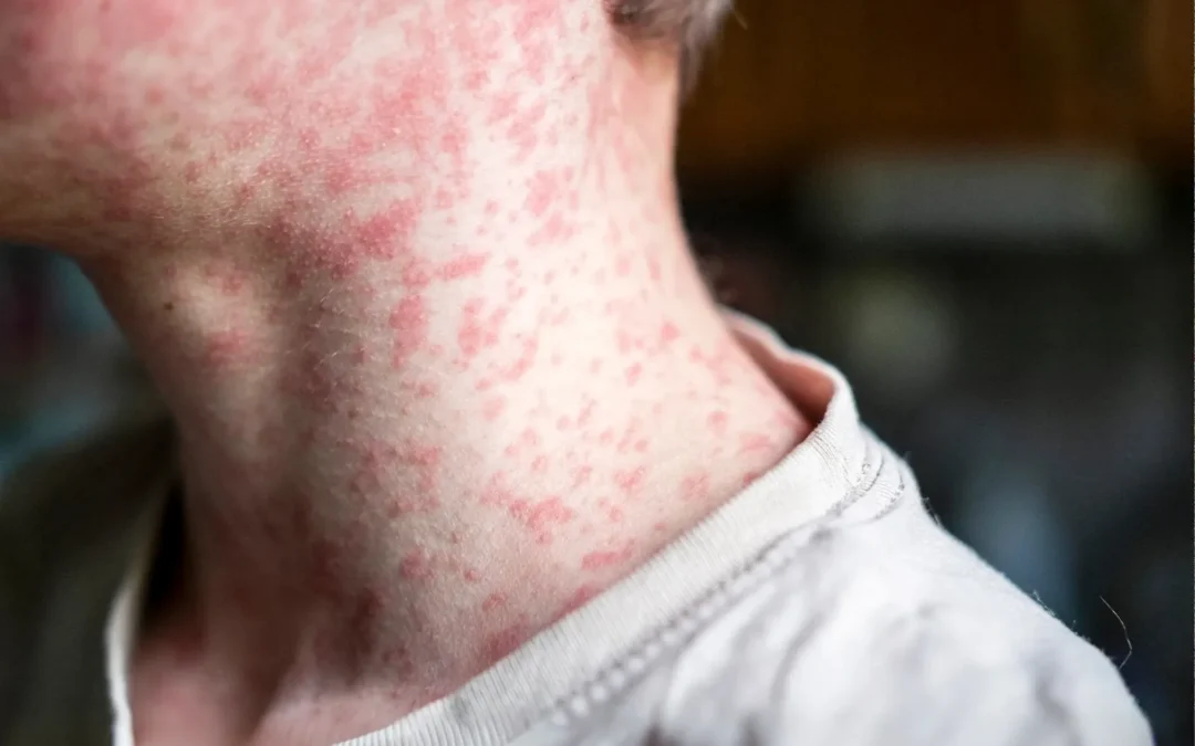 Chile activó alerta sanitaria y reforzó sus controles por el aumento de casos de sarampión en Argentina