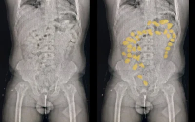 Detuvieron a dos pasajeros que iban de La Rioja a Salta con cápsulas dentro de su estómago que contenían 755 gramos de cocaína