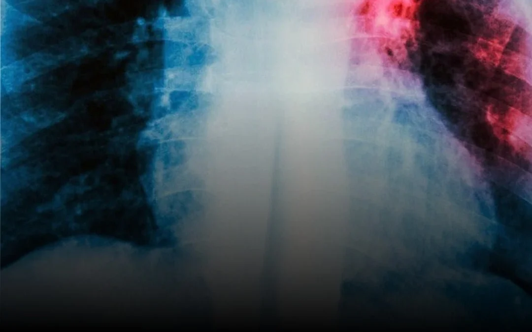 Los casos de tuberculosis crecieron 71,6% en Argentina desde 2020